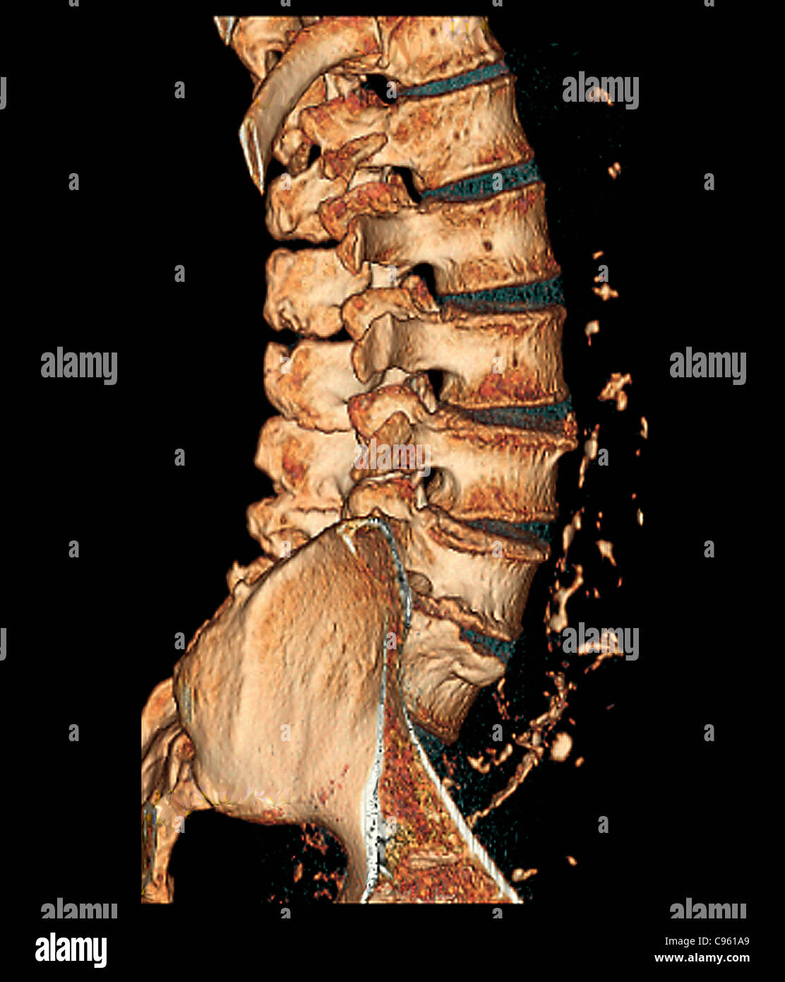 Degenerative Bandscheibenerkrankungen, 3D CT-scan Stockfoto