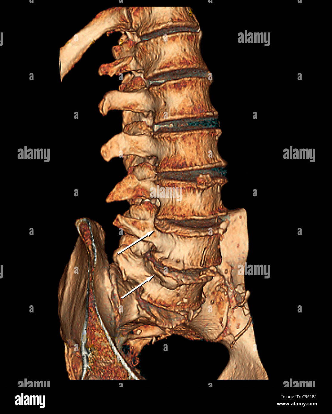 Degenerative Bandscheibenerkrankungen, 3D CT-scan Stockfoto