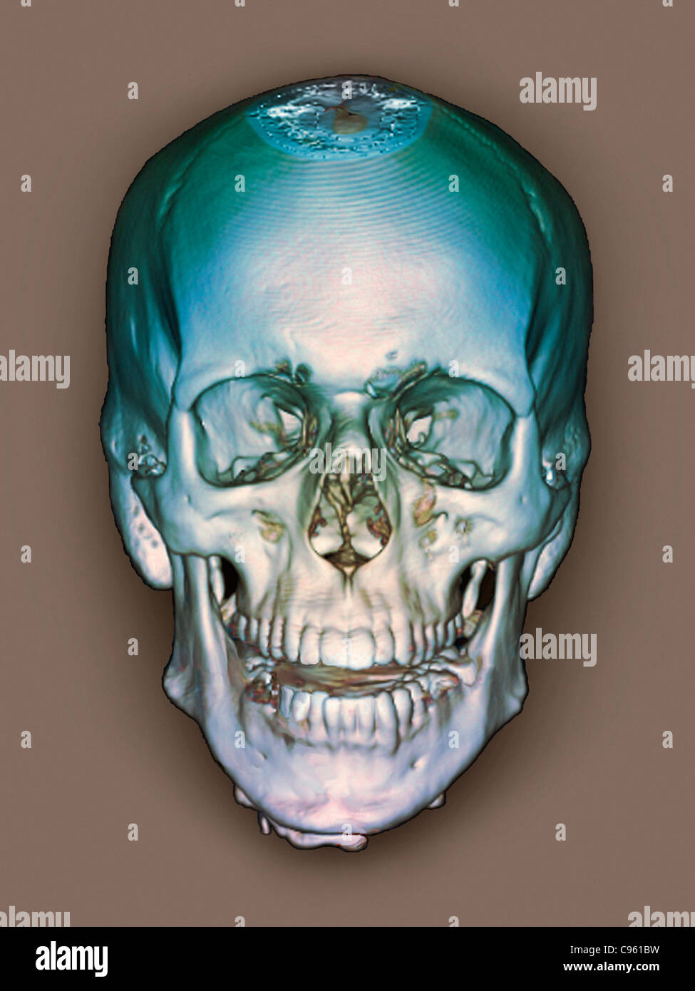 Normale Schädel. Farbige 3D Computertomographie (CT) Scan des Schädels eines 36 Jahre alten Patienten gesund. Stockfoto