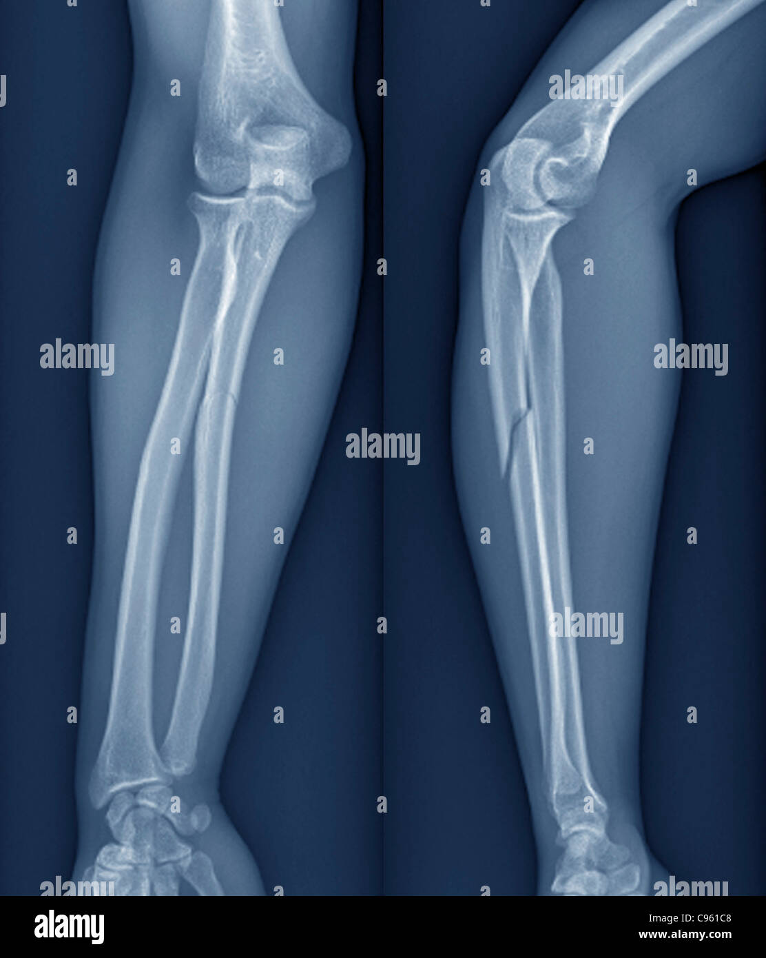 Gebrochenen Arm. X-ray den Arm eines 20 Jahre alten Patienten mit einem gebrochenen Radius (Unterarm-Bone). Stockfoto