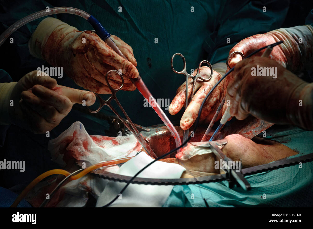 Detail der Ärzte, die Durchführung der Operation in einem OP-Saal Stockfoto
