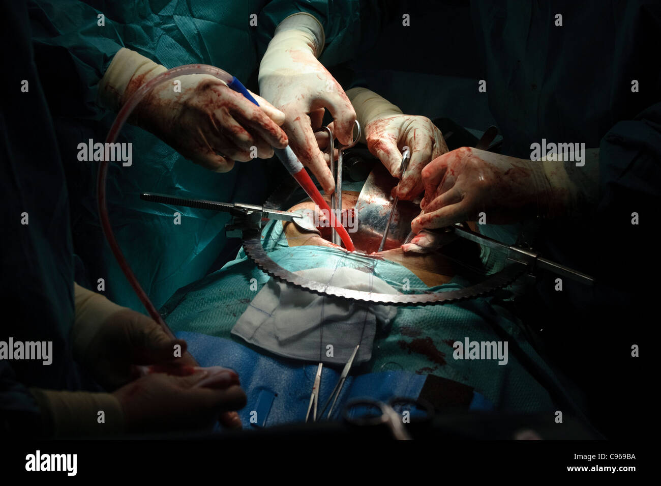 Detail der Ärzte, die Durchführung der Operation in einem OP-Saal Stockfoto