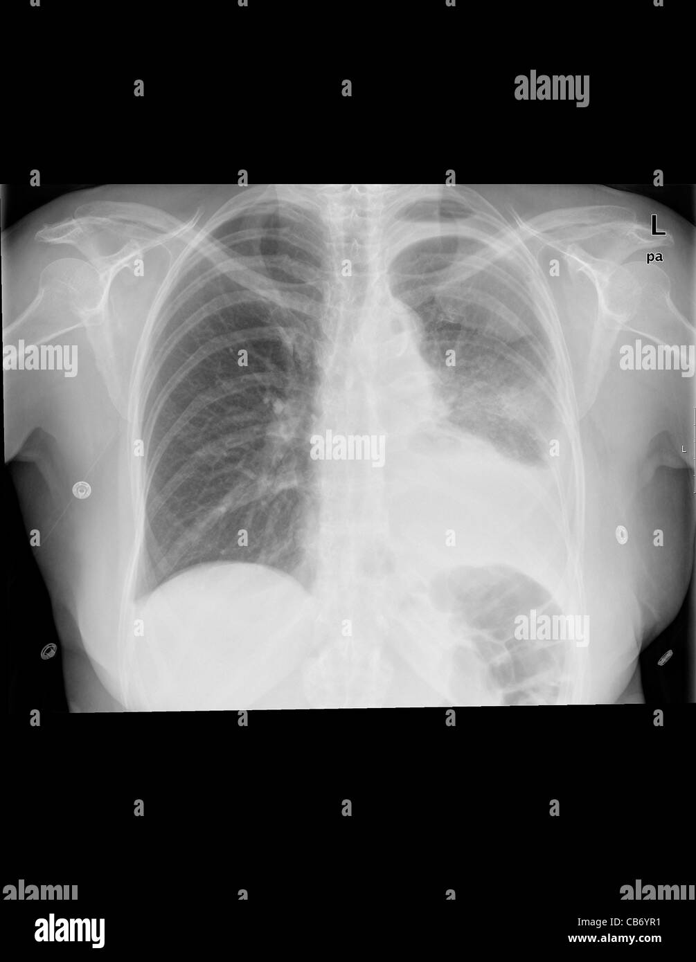 X-ray eine 65-jährige Patientin mit Pleuraerguss Stockfoto