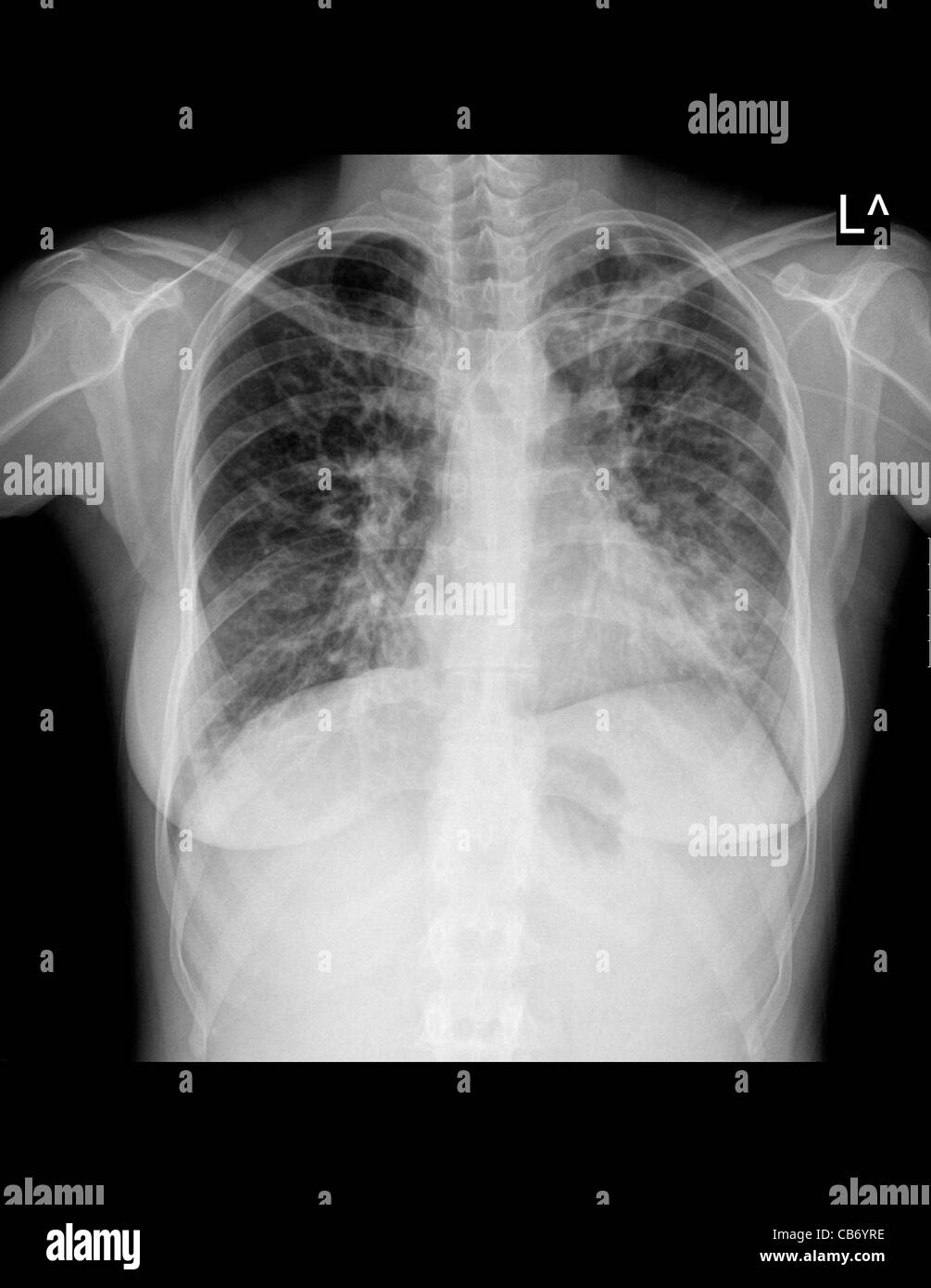 Röntgen-Thorax einer 25 Jahre alten Patientin Dyspnoe verursacht durch Mukoviszidose leiden Stockfoto