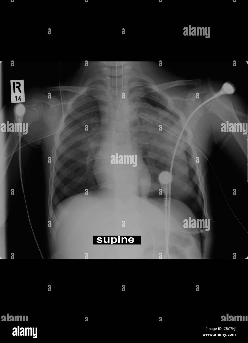 Patienten Röntgen 4 Jahre altes Mädchen Verkehrsopfer mit Bronchus Verletzung Stockfoto