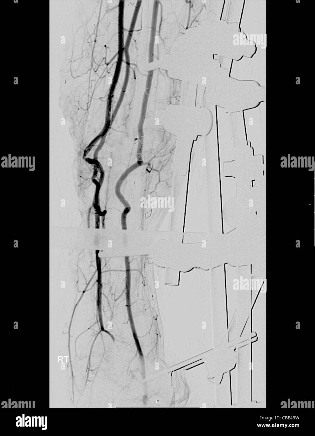 X-ray von Tibia und Fibula eines 23 Jahre alten männlichen Patienten. Metall-Fixes wurden eingefügt, um einen Knochenbruch zu beheben. Stockfoto