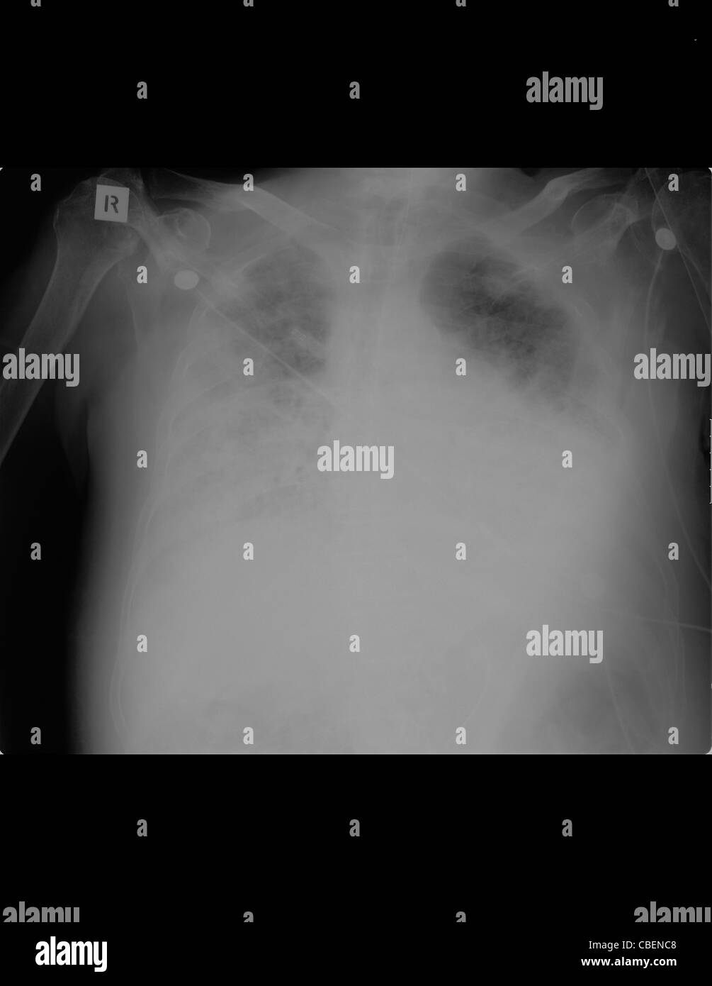 RöntgenThorax einer 84 Jahre alten männlichen Patienten metabolische