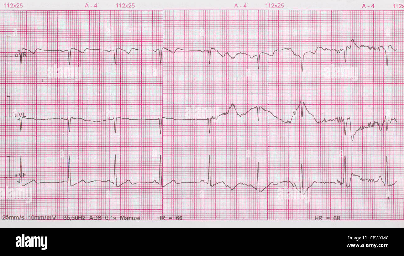 Ekg Ausdruck Stockfoto