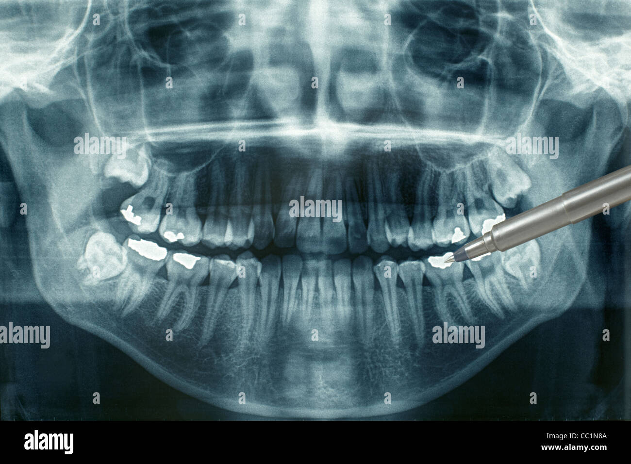 Dental xray Stockfoto