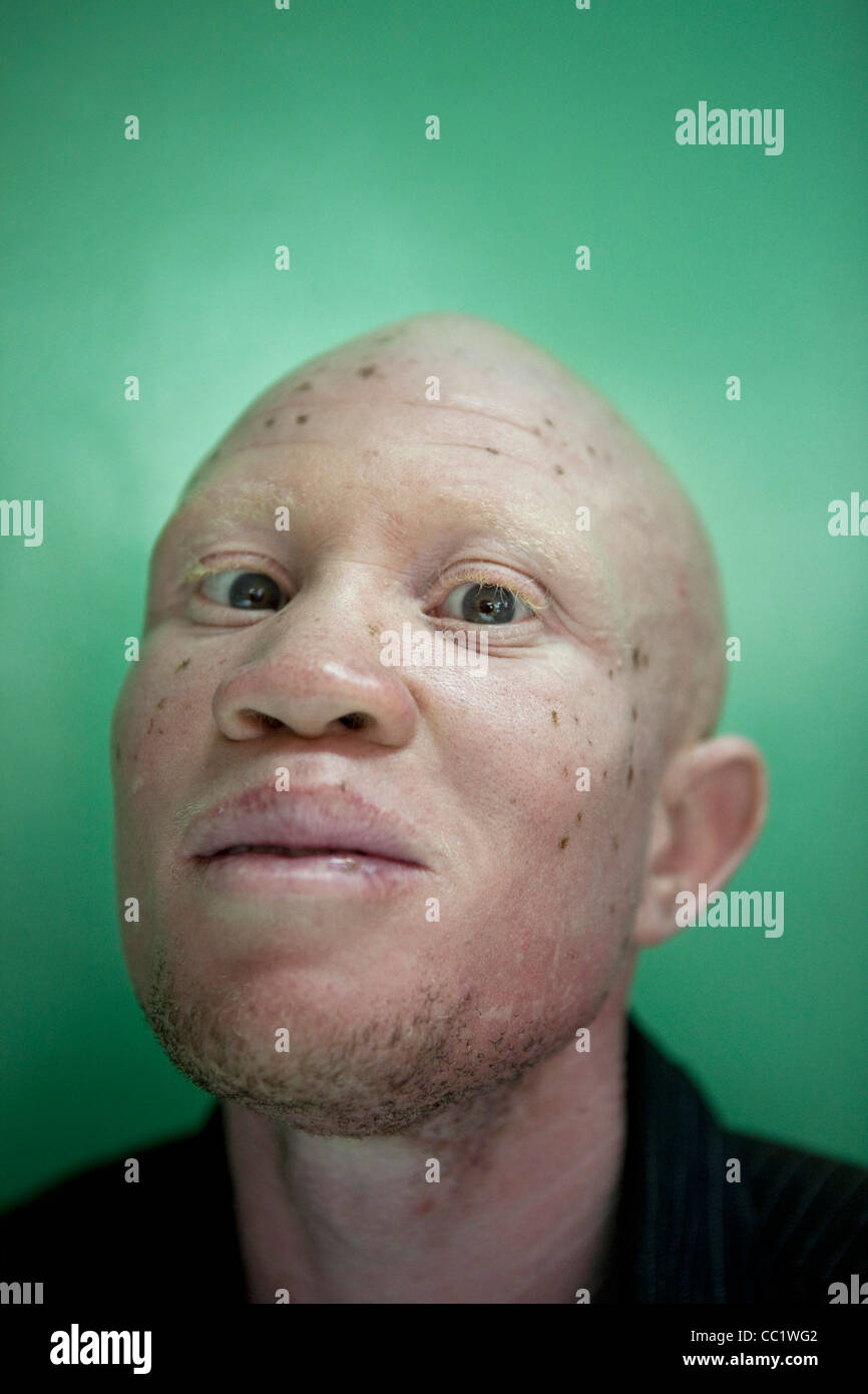 Albino in Uganda Stockfotografie Alamy