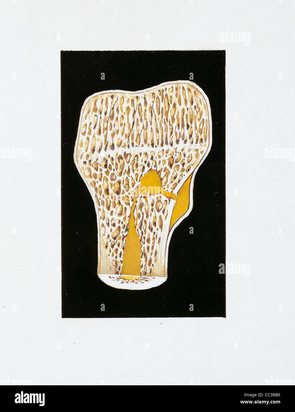 Medizin - Anatomie - Pathologie - Bewegungsapparat (Bewegungsapparat) - Skelett - Osteomyelitis Fokus. Zeichnung. Stockfoto