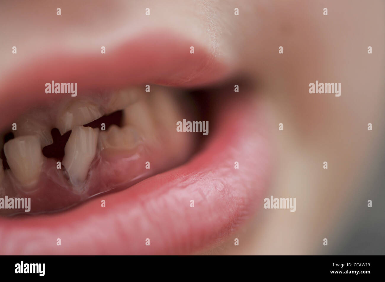 Zahn Verlieren Stockfotos und -bilder Kaufen - Alamy