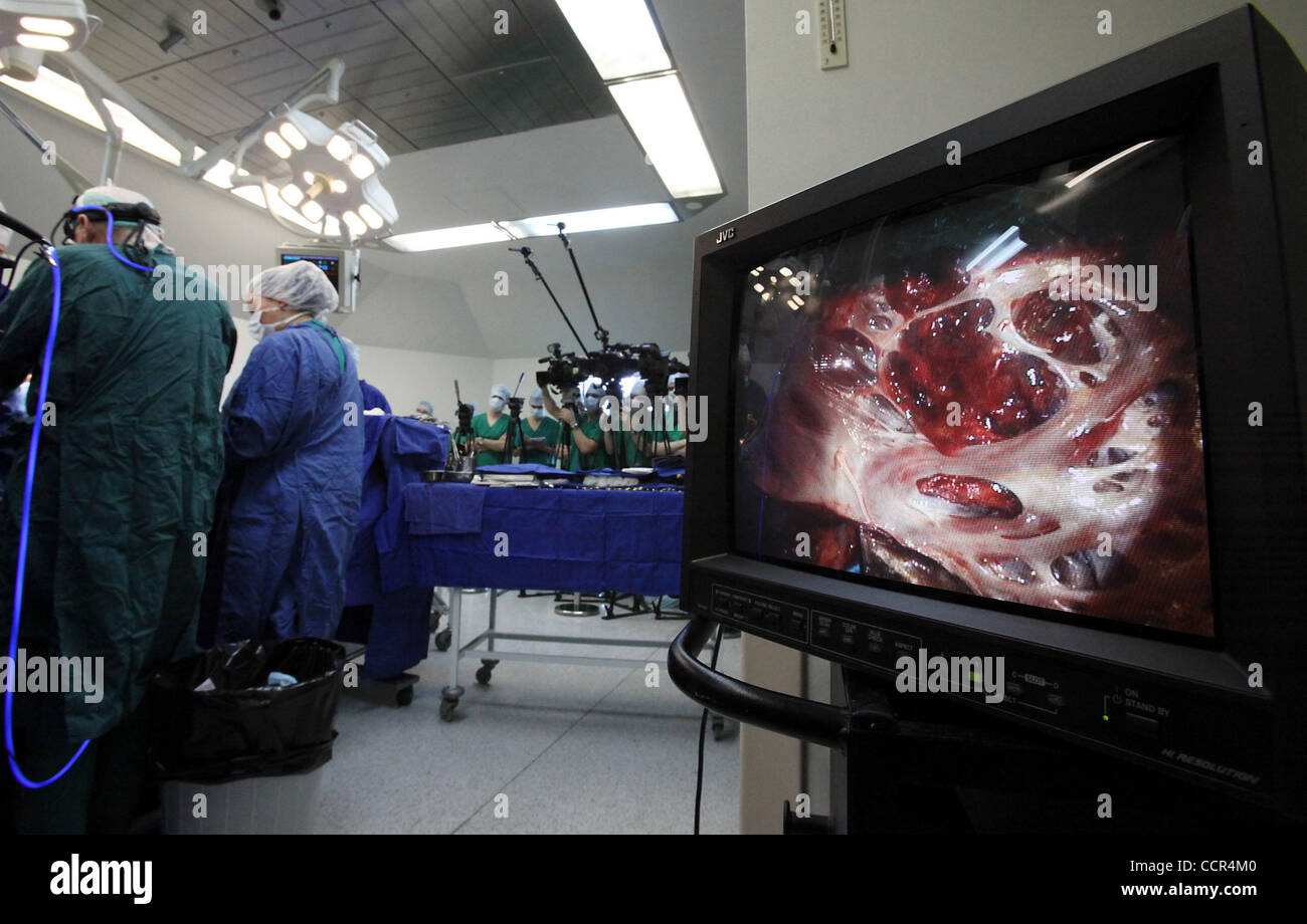 Tannen in Russland Betrieb, ein menschliches Wesen zu geben eine Herz-Implantat gelungen, Bakulev Wissenschaftszentrum für kardiovaskuläre Chirurgie von Moskau. Stockfoto