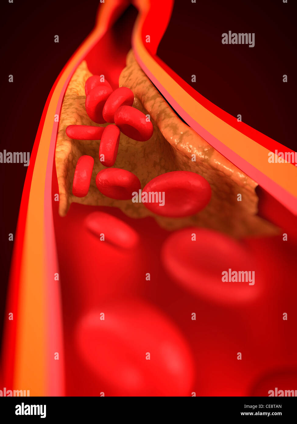 Verengten Arterie. Computer-Grafik einer Arterie, die teilweise durch ein Atherom blockiert ist. Stockfoto