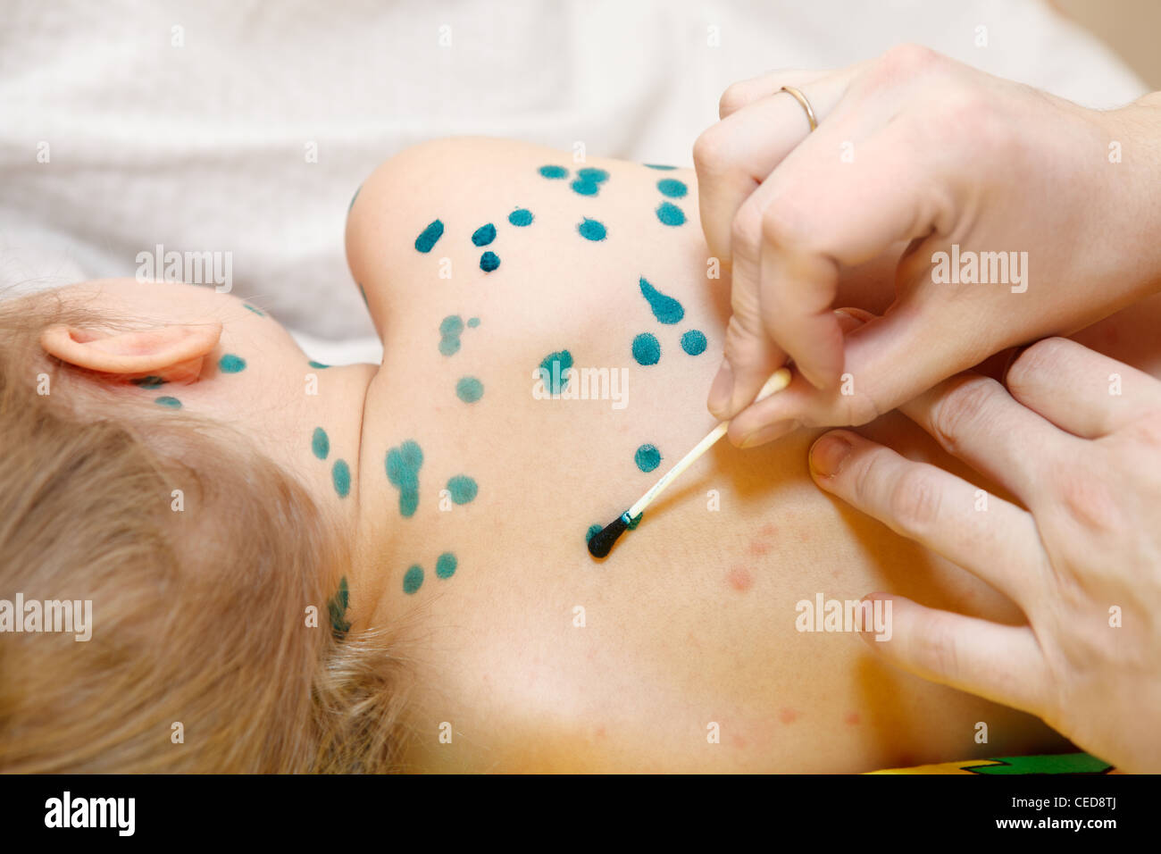 Varicella Zoster Virus Stockfotos & Varicella Zoster Virus Bilder - Alamy