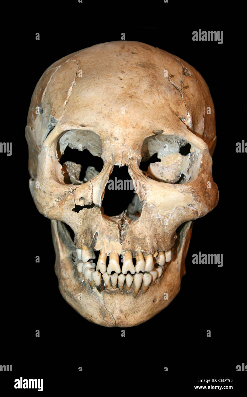 Frontale Ansicht Cranially verformt menschlicher Schädel aus Costa Rica Stockfoto