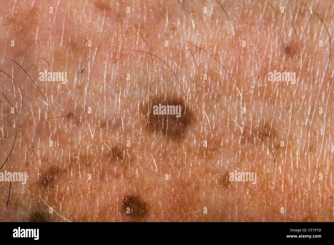 Altersflecken vor Ort Haut alte Problem Krebs entdeckt Nahaufnahme Closeup Makro Makro Dot braun kupferbraun alte Mann Gefahr gefährlich Stockfoto
