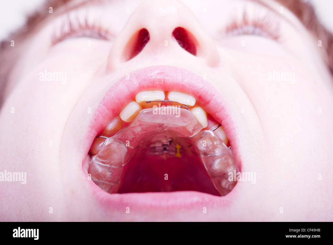Ein 12-jähriger Junge zeigt seine zahnärztliche Klammer für seine Zähne ausgestattet in England, Großbritannien, Uk Stockfoto