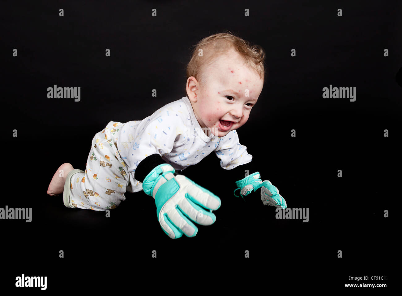 kleiner Junge mit Windpocken Stockfoto