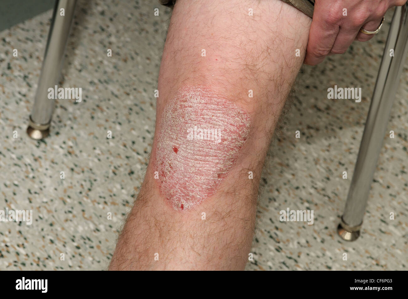 Plaque-Psoriasis auf den Knien ein erwachsener Mann, 50 Jahre alt Stockfoto
