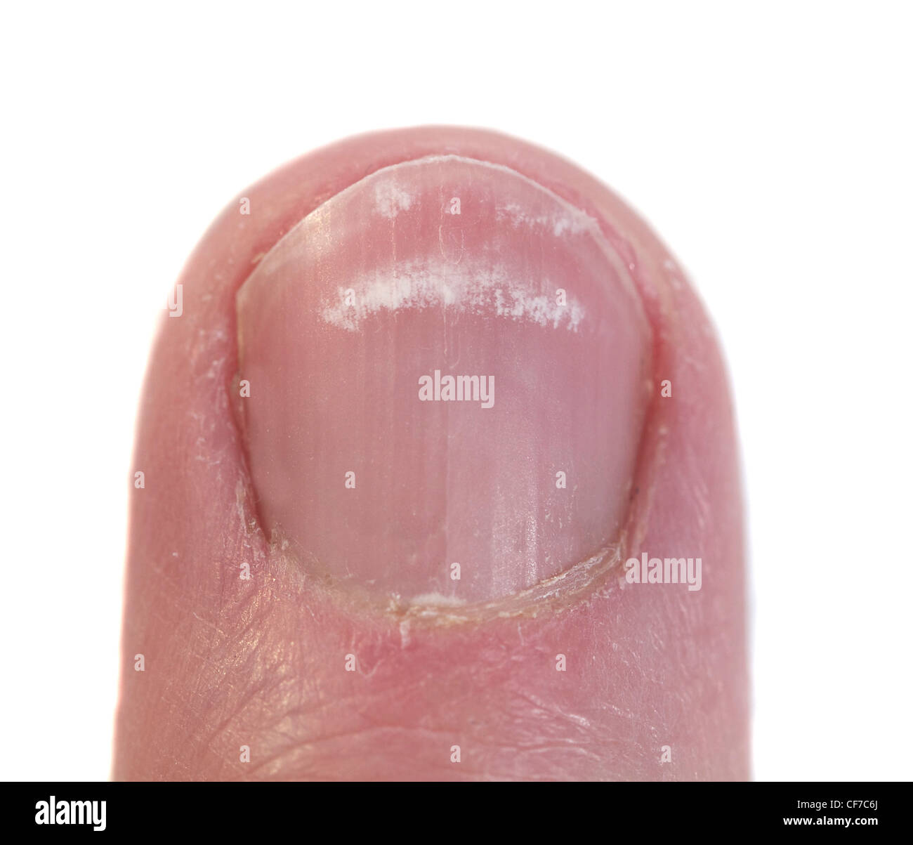 Fingernagel Closeup mit der Bedingung genannt Leukonychia, weiße Linien