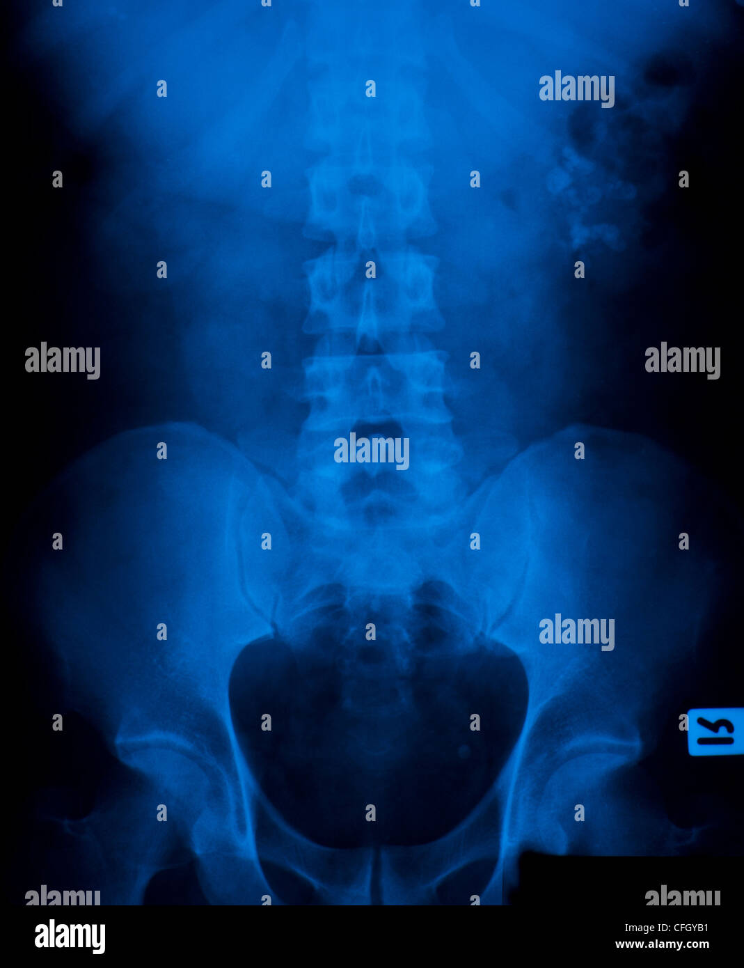 X-ray Film aus Stein in der Blase. Stockfoto