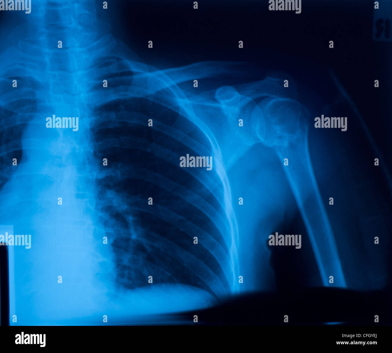 Röntgenfilm Schulter Fraktur. Stockfoto