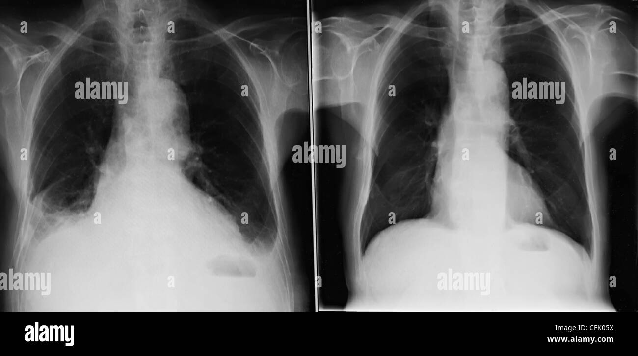Röntgenaufnahmen der gleichen männlichen Brust zu verschiedenen Zeitpunkten mit der linken Seite zeigt eine Pilzinfektion und das Recht einer normalen Lunge UK Stockfoto