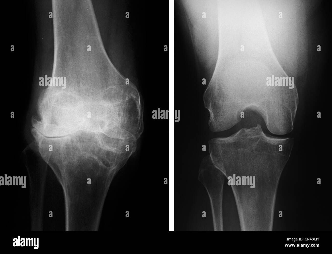 Röntgenstrahlen zeigen ein Knie mit schweren degenerativen Veränderungen (links) und den Verlust des gemeinsamen Raumes mit einem normalen Knie (rechts) Stockfoto