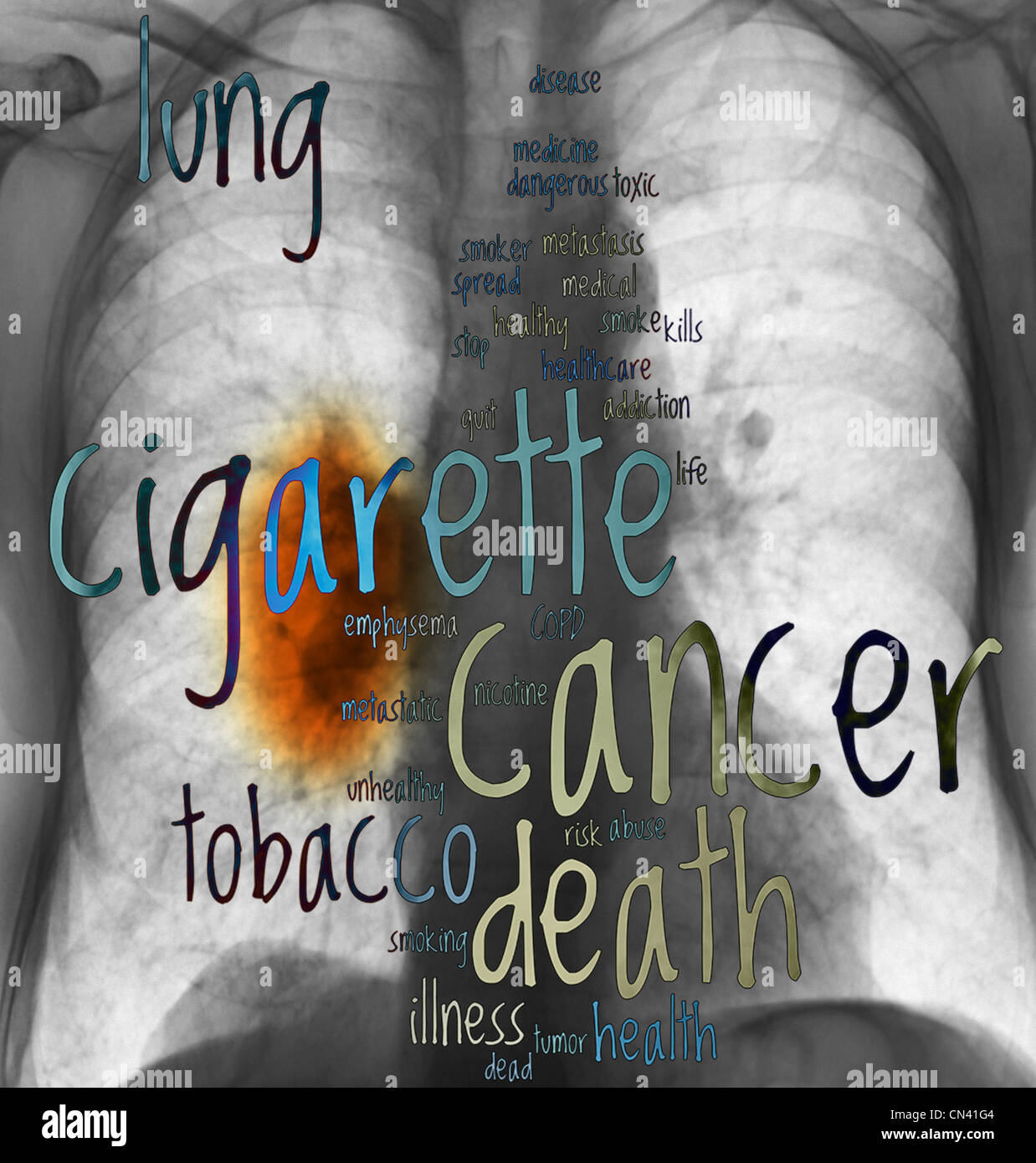 Röntgen-Thorax zeigt einen große Lungenkrebs mit überlagerten Wörter Stockfoto