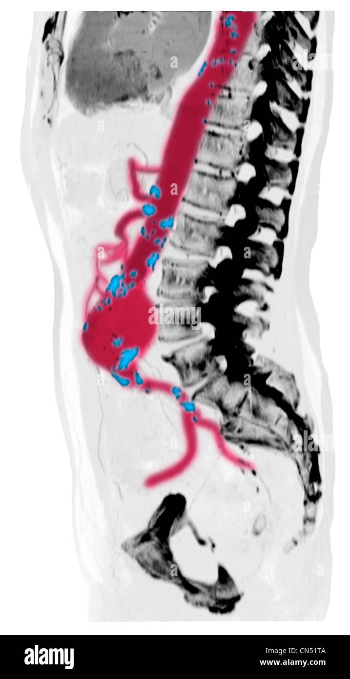 CT-Scan-Bilder zeigen einen abdominalen Aortenaneurysma Stockfoto