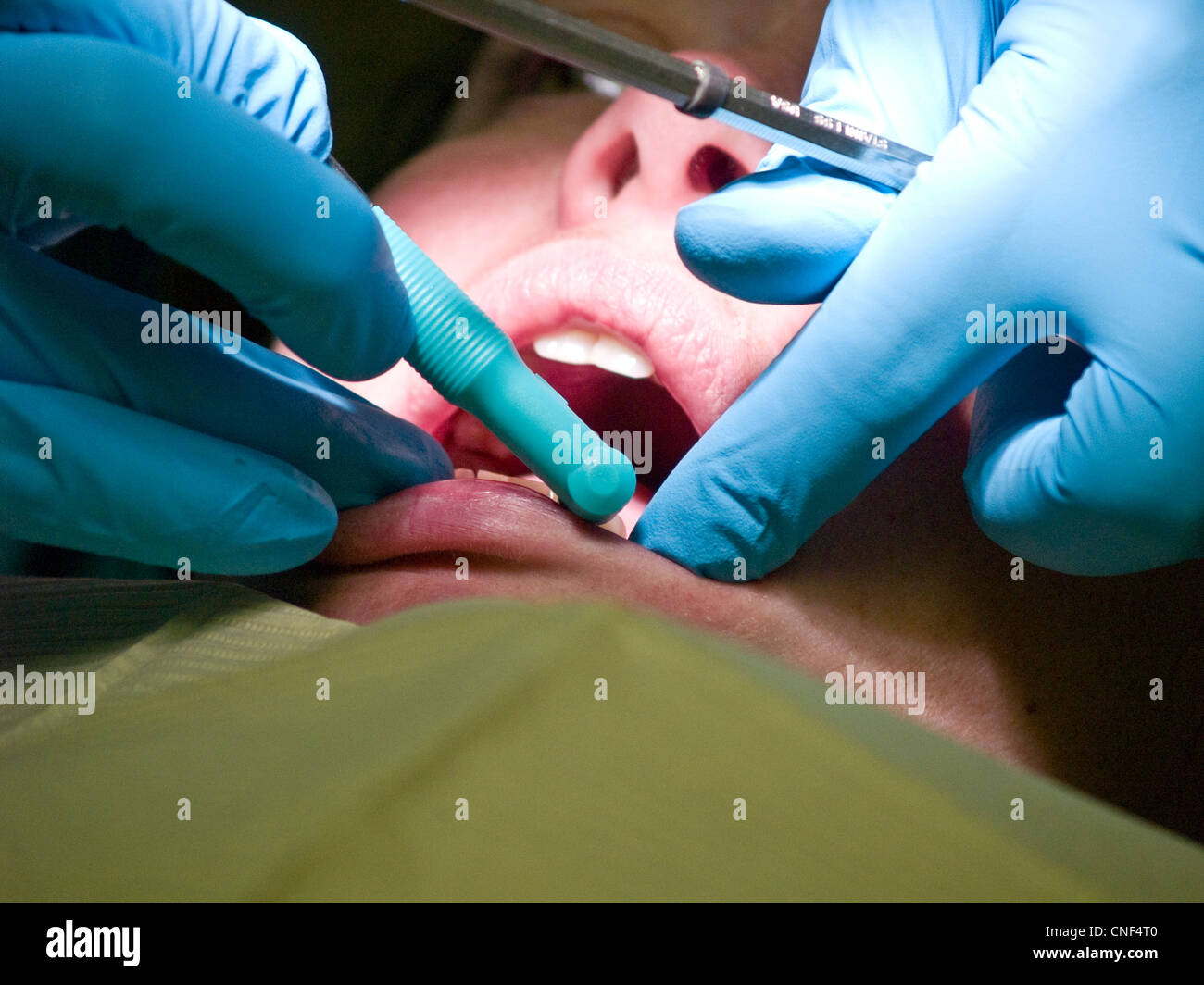 Eine Frau hat ihre Zähne gereinigt durch einen Zahnarzt vor, die eine Wurzelbehandlung durchgeführt. Closeup Aufnahme von Mund, Händen und th des Arztes Stockfoto