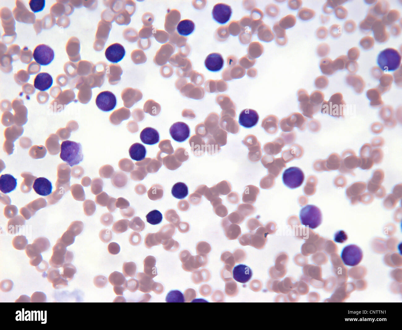 Neoplastischen Lymphozyten Zellen im Blut Stockfoto