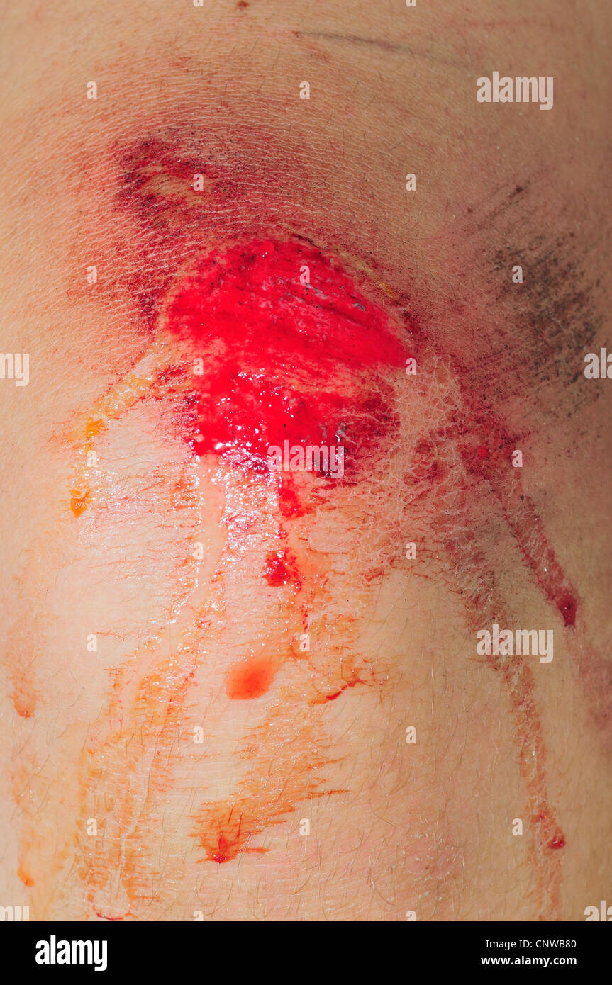 Abrieb am Knie des Kindes - offene Wunde mit Blut Stockfoto