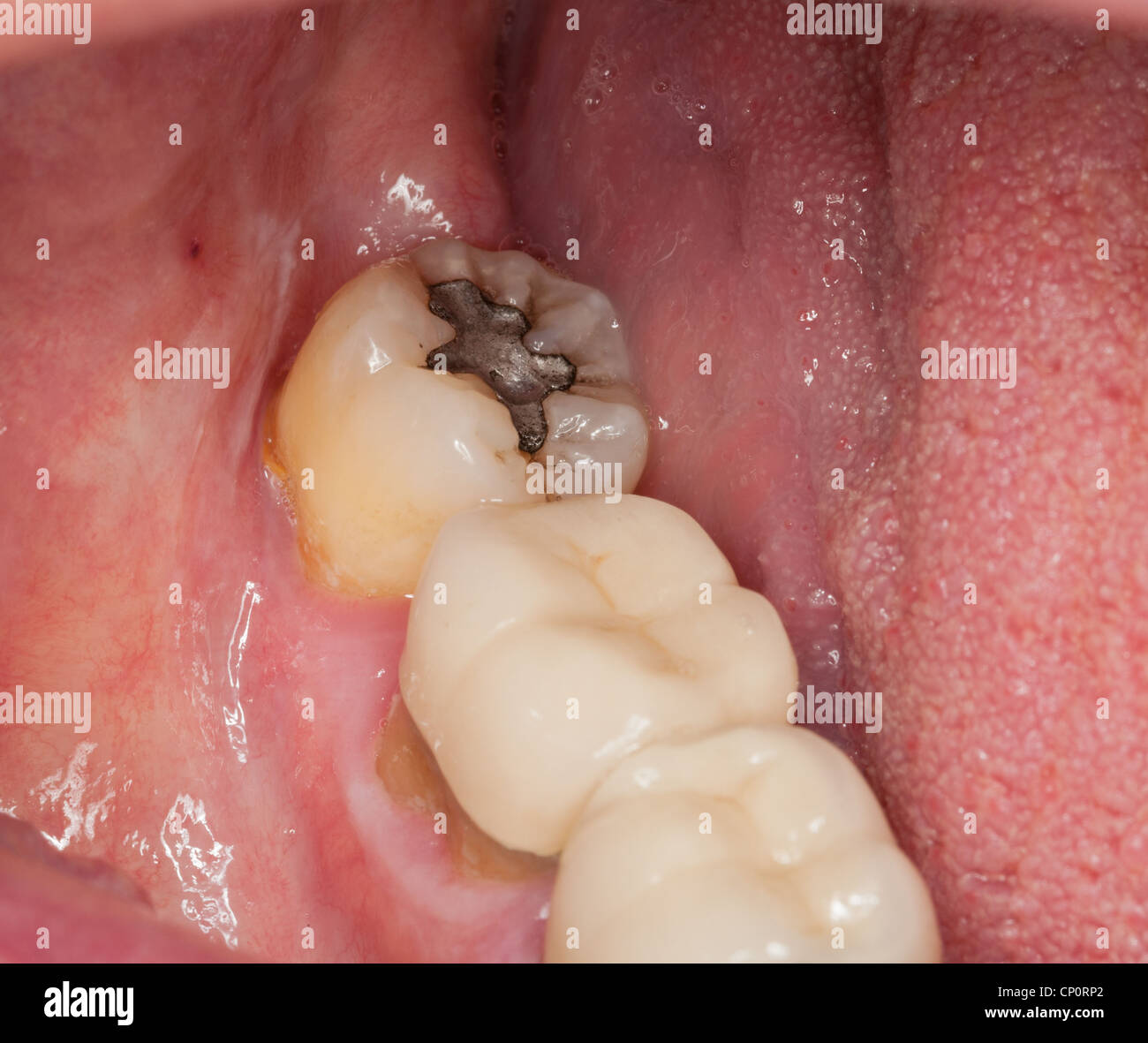 Nahaufnahme Makroaufnahme innere Mund und Füllungen und Kronen auf den Zähnen Stockfoto
