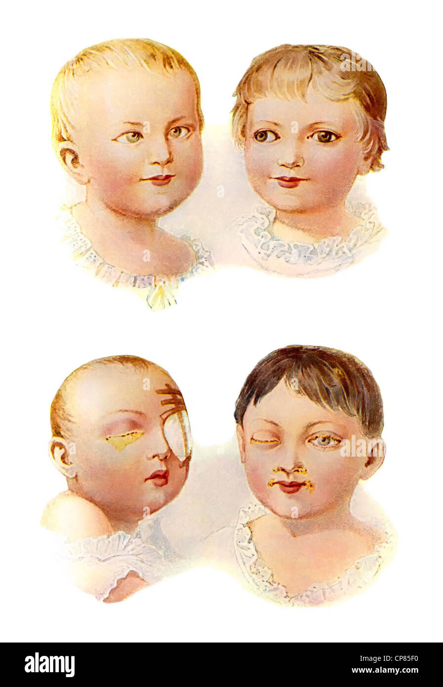 Bilder aus einem medizinischen Buch, Kinder Augenkrankheiten, noch aus Einem Zwang Buch, Augenkrankheiten Im Kindesalter Stockfoto