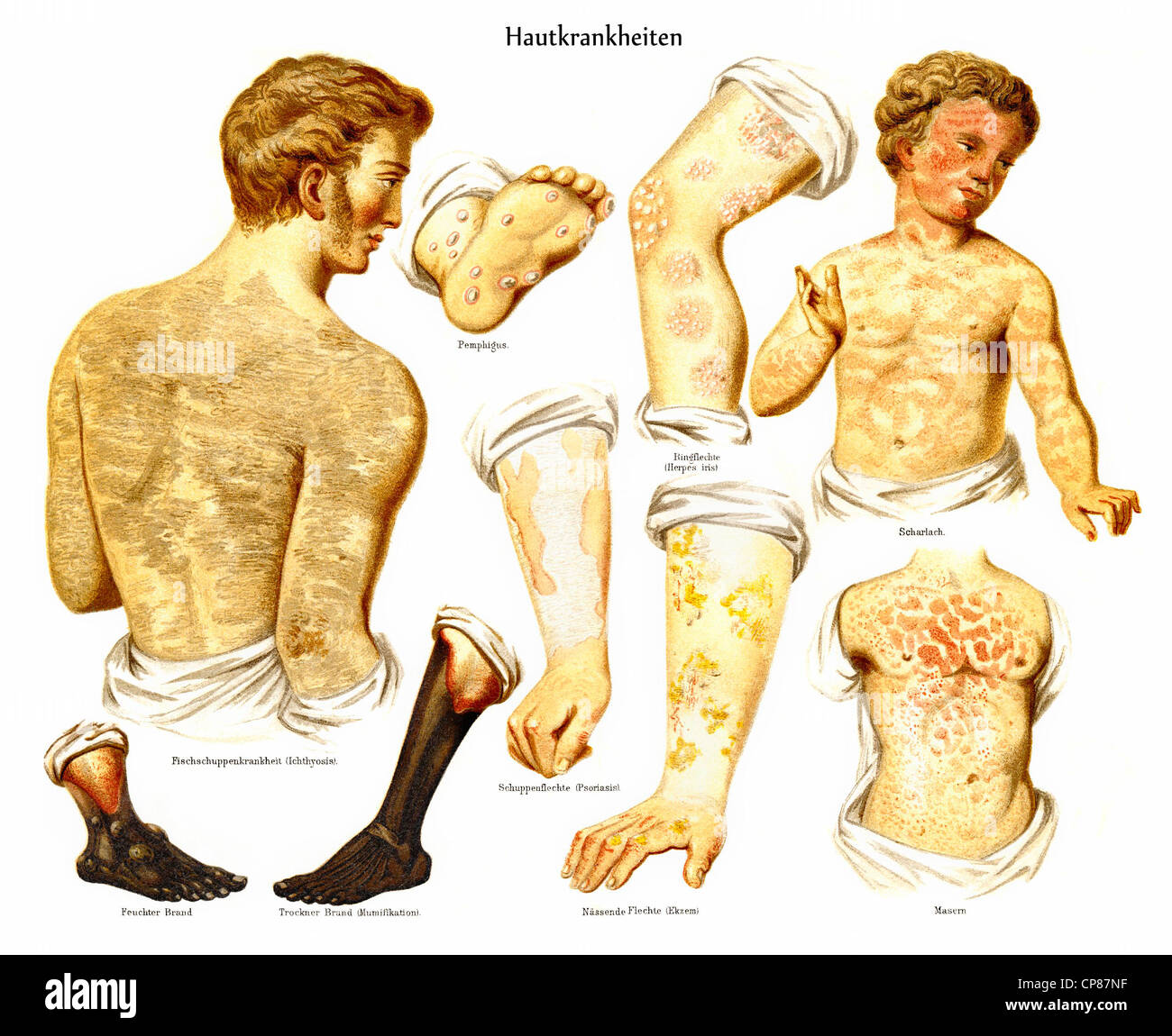 Haut, Krankheiten, Dermatosen, Masern, Scharlach, Schuppenflechte, Herpes, Historische, Zeichnerische Darstellung, Hautkrankheiten (D Stockfoto