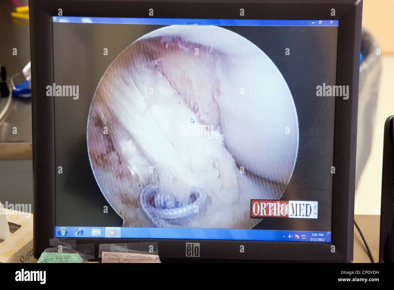 Arthroskopische Knieoperation auf einem Krankenhaus-OP-Saal-Computer-Monitor angezeigt Stockfoto