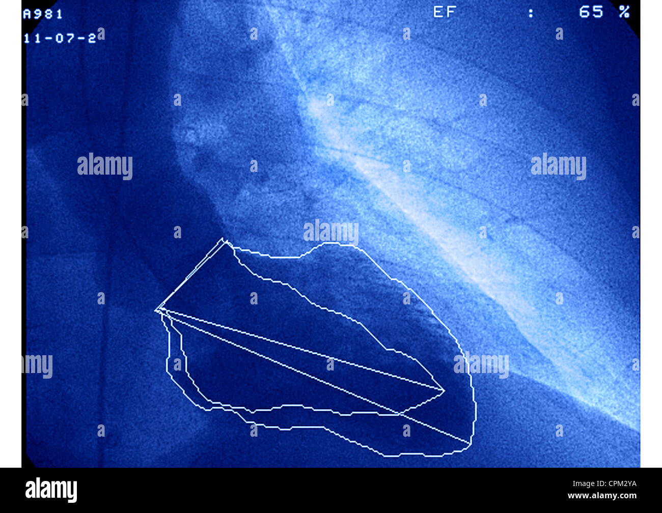 HERZINFARKT VENTRICULOGRAPHY Stockfoto