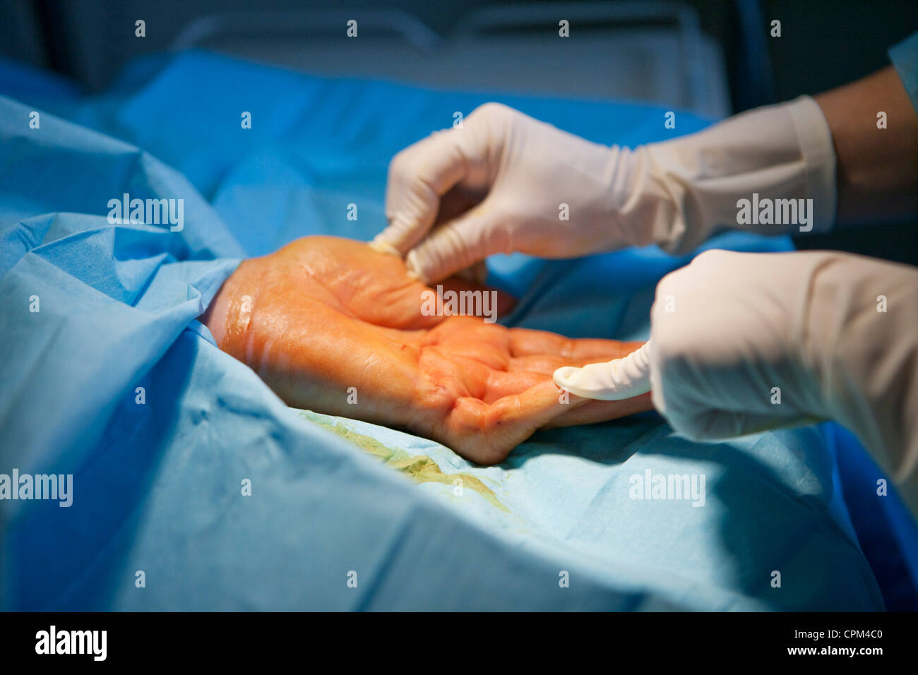 Fasziotomie Fotos und Bildmaterial in hoher Auflösung Alamy