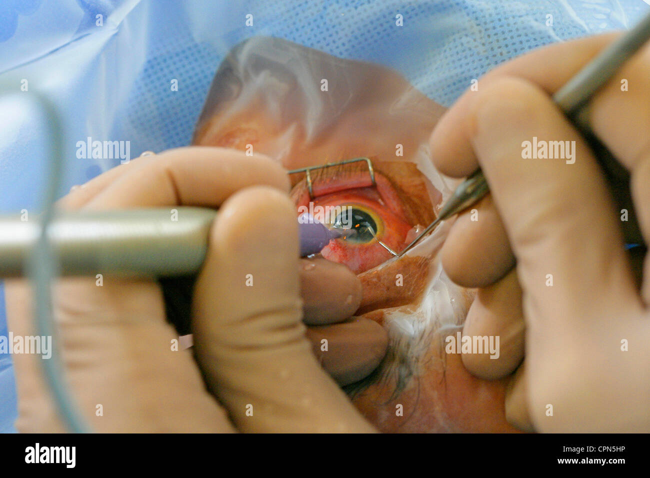 KATARAKT CHIRURGIE Stockfoto