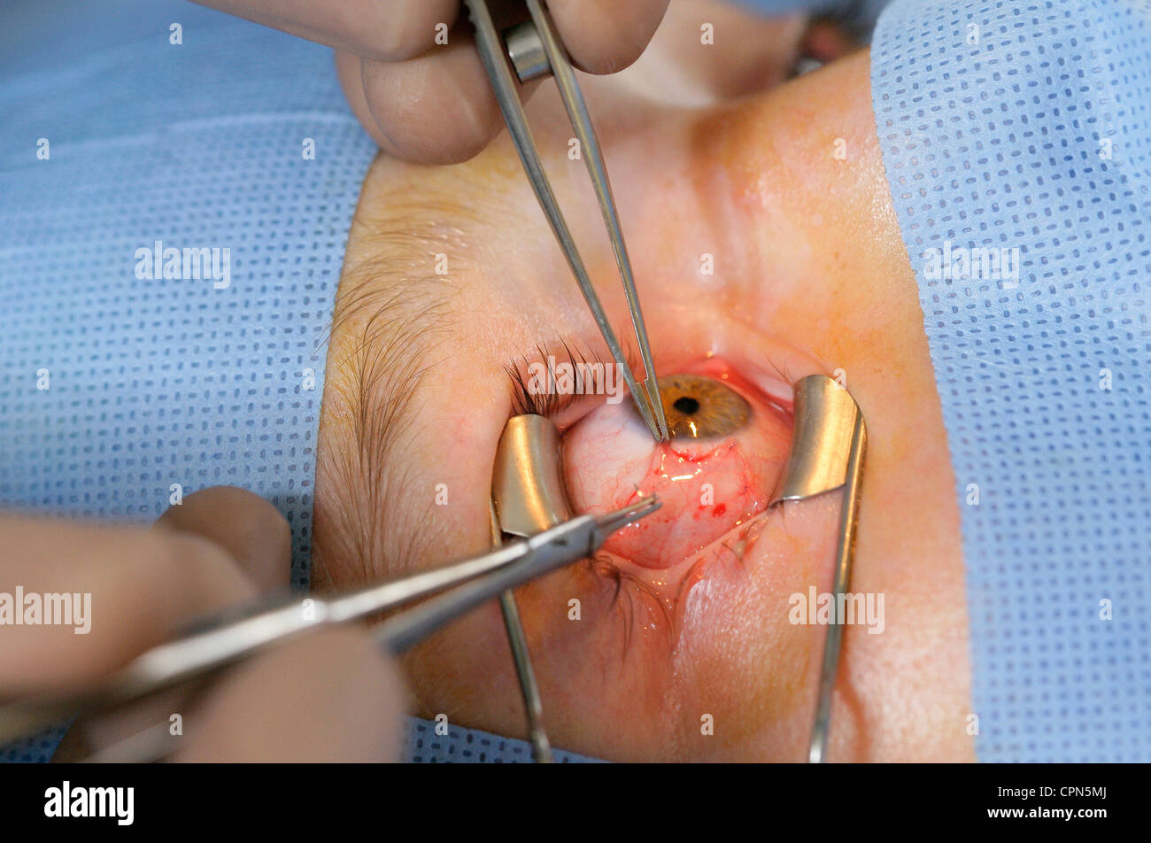 STRABISMUS, CHIRURGIE Stockfoto