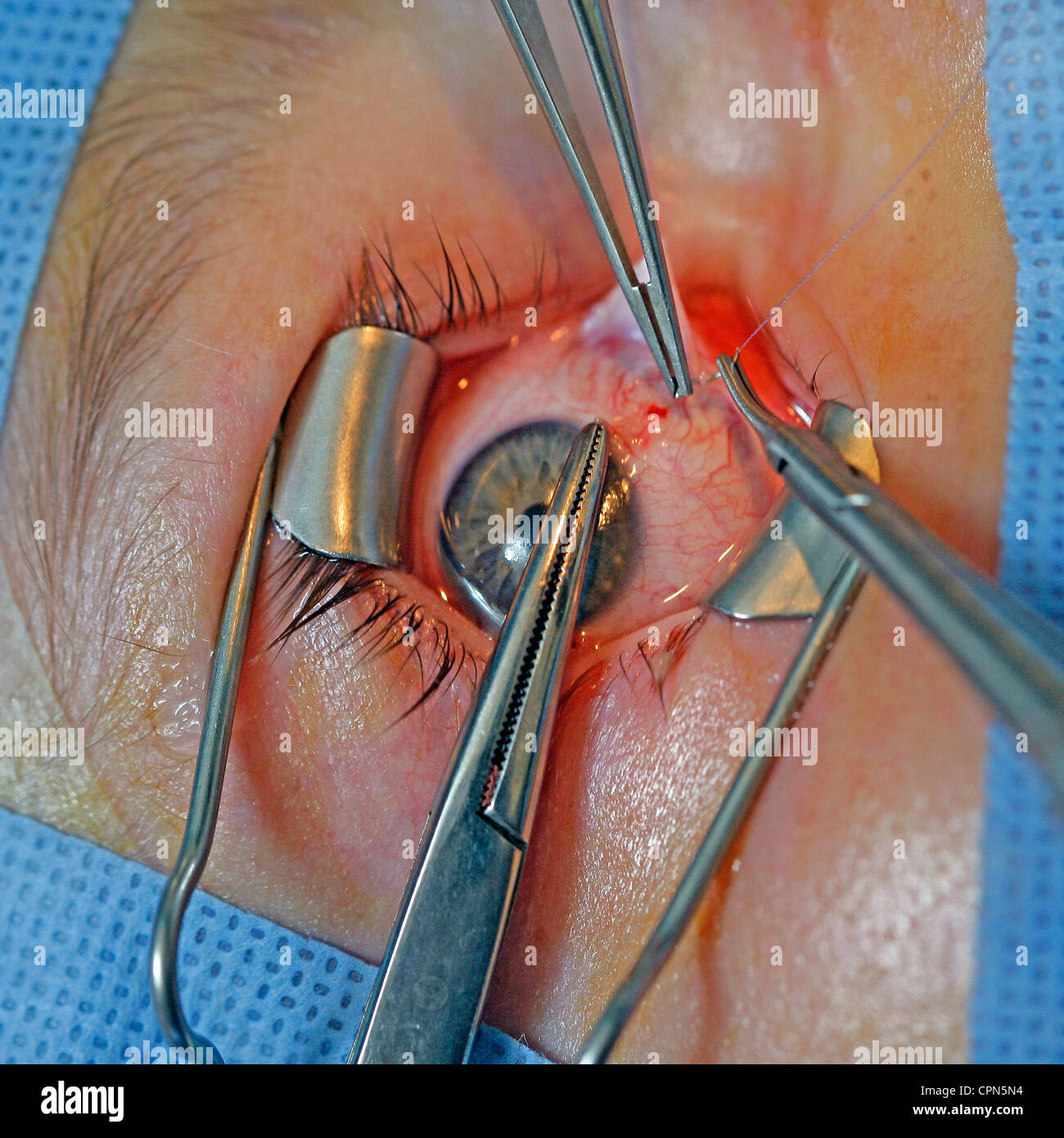 STRABISMUS, CHIRURGIE Stockfoto