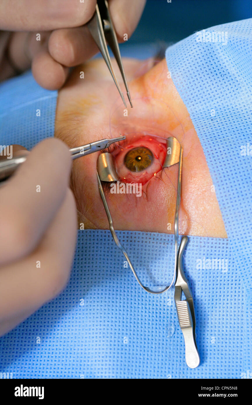 STRABISMUS, CHIRURGIE Stockfoto