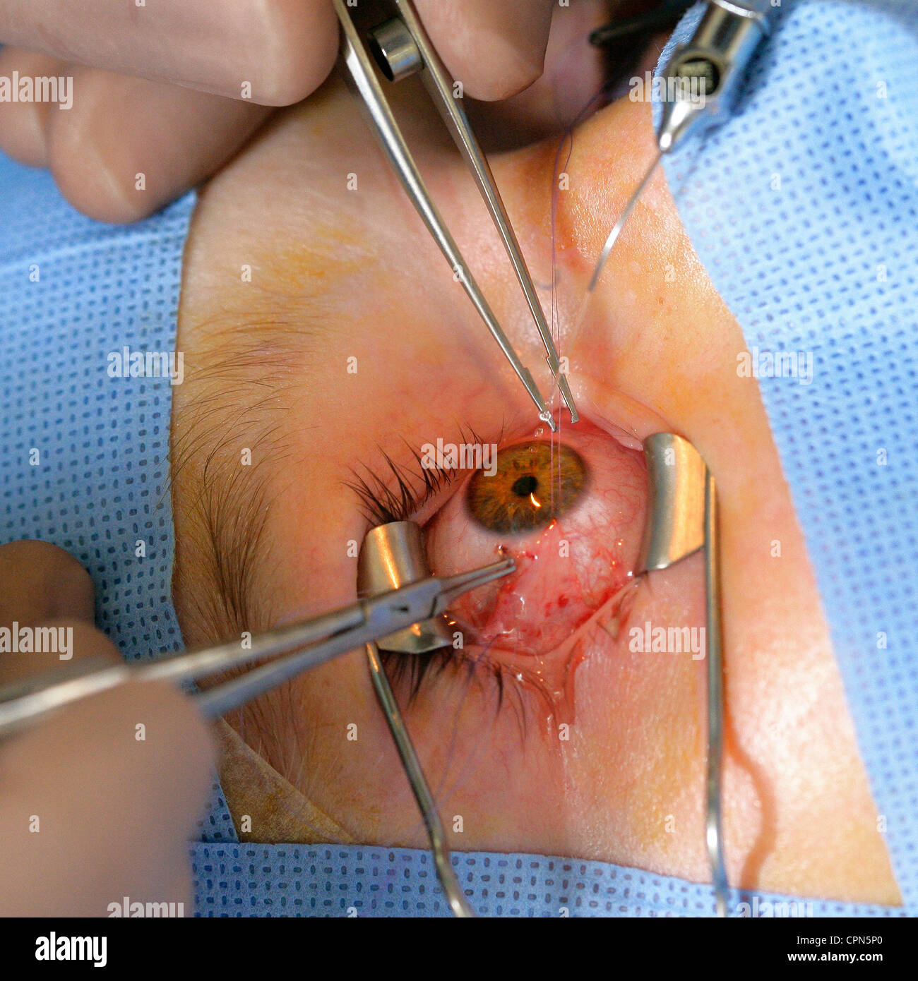 STRABISMUS, CHIRURGIE Stockfoto