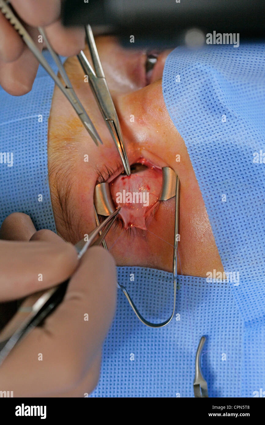 STRABISMUS, CHIRURGIE Stockfoto