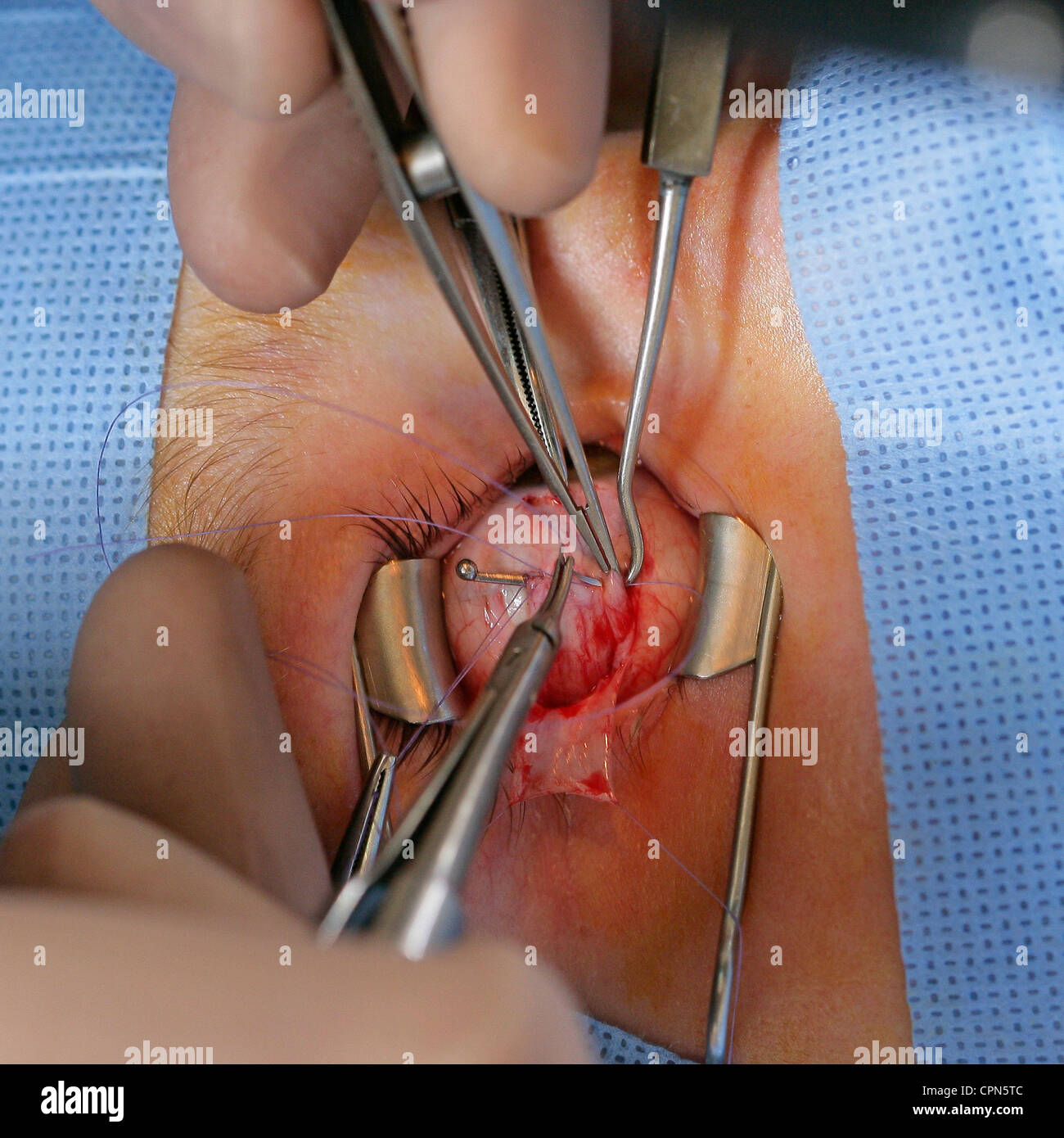 STRABISMUS, CHIRURGIE Stockfoto