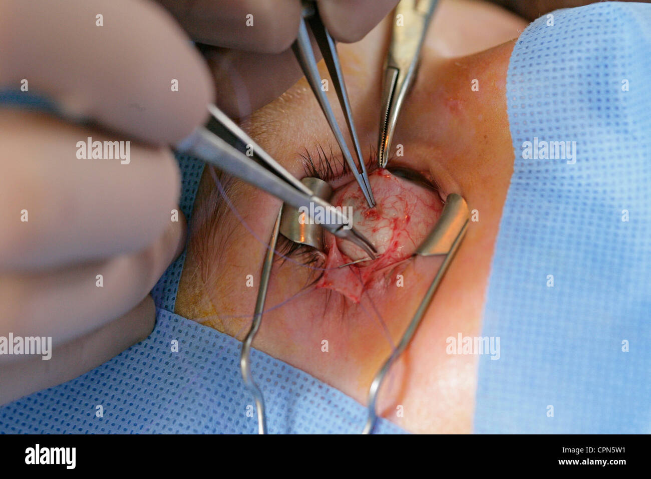 STRABISMUS, CHIRURGIE Stockfoto