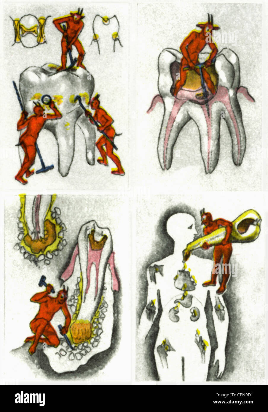 Medizin, Zahnmedizin, Zahnführung mit Darstellung der Zahnlosigkeit, kleine rote Teufel zerstören den Zahn, Erinnerung an die medizinische Versorgung, Deutschland, um 1930, Zusatz-Rechte-Clearenzen-nicht vorhanden Stockfoto