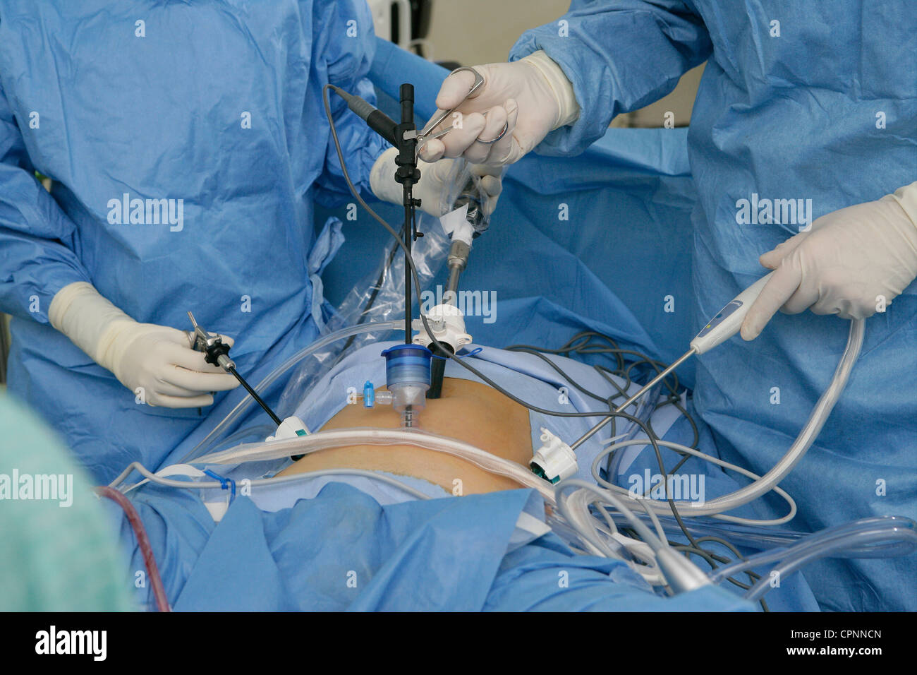 MYOMEKTOMIE Stockfoto